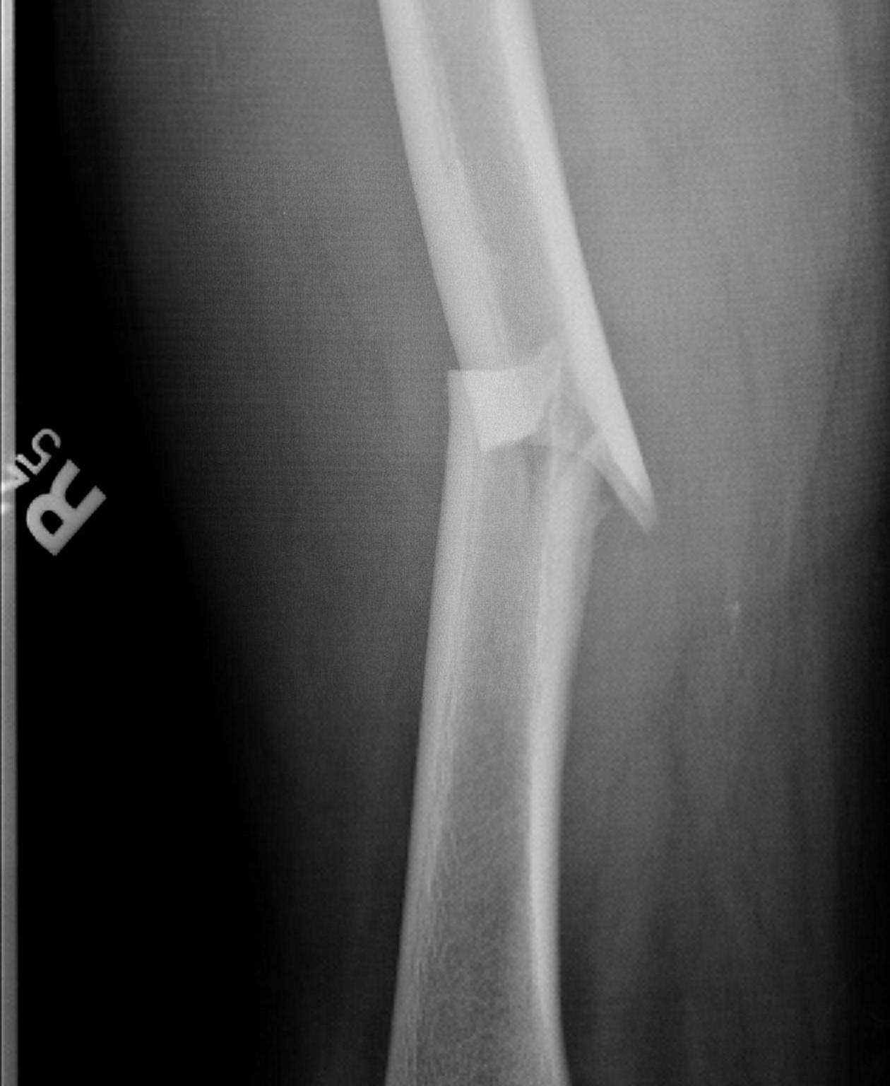 Femoral Shaft Fracture No comminution